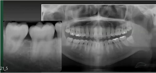 Ca lâm sàng R46 ngầm kẹt được kéo thành công và tái tạo xương tốt